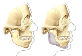 Mandibular angle and anatomic chin implant augmentation