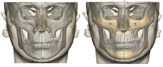 skeleton_facial_implant
