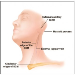 Figure 1. Preoperative and intraoperative anatomic landmarks for the location of the great auricular nerve. SCM, sternocleidomastoid. 