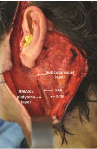 Figure 5. Lateral border of the superficial musculoaponeurotic system (SMAS)â€“platysma flap just medial to the anterior border of the sternocleidomastoid (SCM). The great auricular nerve (GAN) is shown deep to the SMAS flap and immediately superficial to the belly of the SCM. 