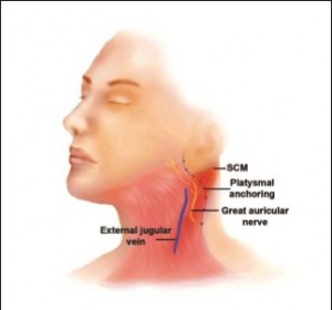 Figure 6. Anchoring of the superficial musculoaponeurotic system (SMAS)â€“platysma layer to a safer zone posterior to the great auricular nerve. SCM, sternocleidomastoid.