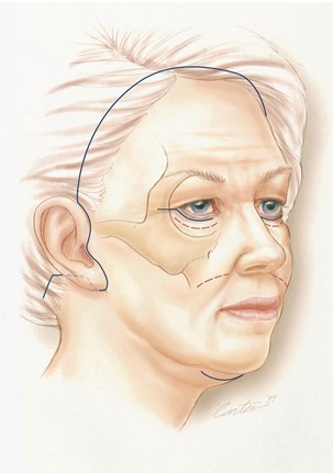 FIG. 6. Incisions for subperiosteal and skin-only rhytidec- tomy. Broken lines represent transconjunctival and intraoral sulcus incisions.