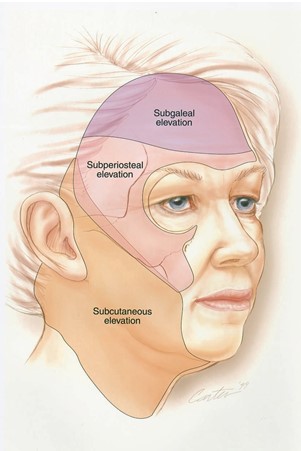 FIG. 7. Plane of dissection for subperiosteal and skin-only rhytidectomy. Extent of dissection in subgaleal, subperios- teal, and subcutaneous planes is presented.