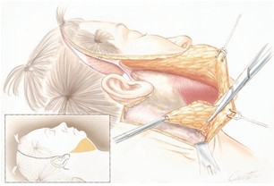 FIG. 9. During the lower face lift, dissection is done di- rectly on the SMAS-platysma anatomic continuum. The man- dibular border and submental area are contoured by remov- ing fat directly from the full-thickness skin and subcutaneous tissue flap