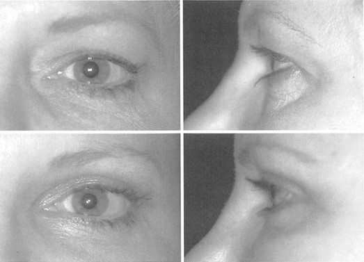 FIG. 3. The preoperative and postoperative appearance of a 48-year-olcl woman who underwent rejuvenative orbital surgery attempting to restore the attributes of youth previously defined by Pessa et al.2 and Farkas3 and demonstrated in Figure 1. A subperiosteal brow and midface lift, conservative upper lid. and skin-only lower lid blepharoplasty1 were performed.