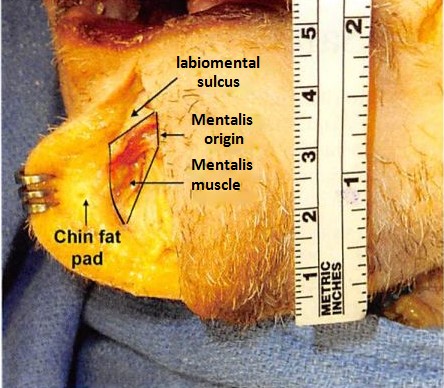 Fig. 2. Cadaveric dissection demonstrating the anatomy, shape, and relationship of the mentalis muscle to surrounding chin structures.
