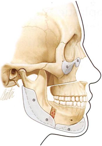 Fig. 1. Artist's rendition of adjunctive use of alloplastic implants to correct skeletal imbalances and irregularities after orthogÂ¬nathic procedures. An implant designed to augment the infraorÂ¬bital rim and anterior malar area corrects the upper midface deÂ¬ficiency after Le Fort I osteotomy and advancement. An implant placed in the posterior mandible smooths the area of narrowing along the inferior border at the sagittal osteotomy site and reÂ¬stores angle projection and ramus height .The extended chin imÂ¬plant, in this case, corrects the step deformity after horizontal osteotomy and adds chin projection.