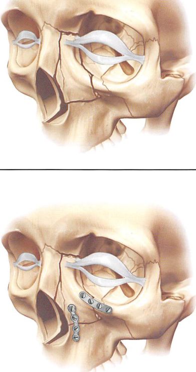 Orbital Deformity After Craniofacial Fracture Repair: Avoidance and ...