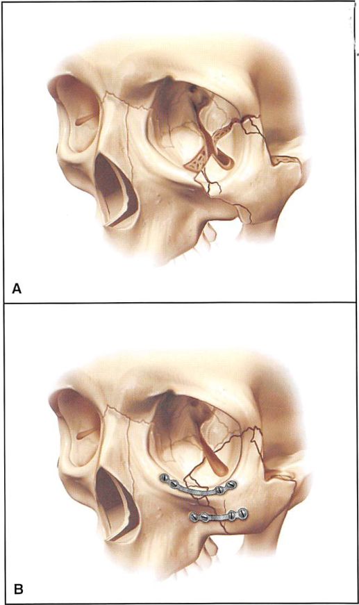 Treatment Fracture Of Zygomatic