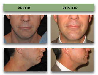 bespoke-plastic-surgery-07