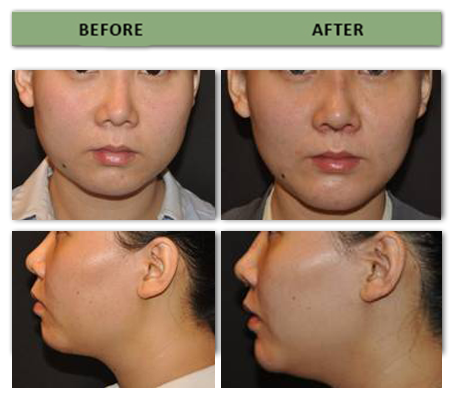 chin-augmentation-and-rhinoplasty