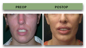 chin-implant-05