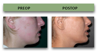 chin-implant-06
