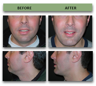 chin-implant-07