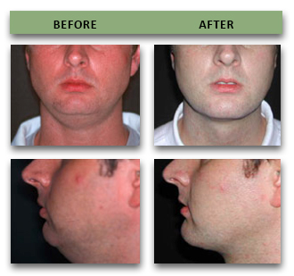 chin-implant-08