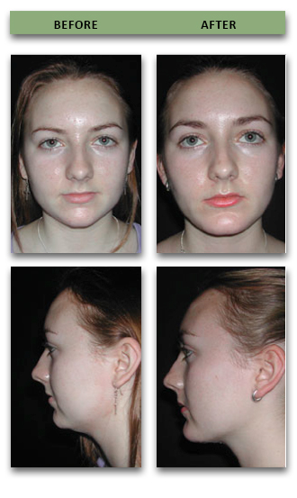chin-implant-10