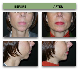 chin-implant-11