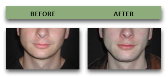 chin-implant-13