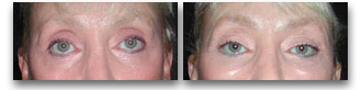 revisional_blepharoplasty01