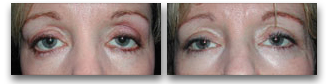 revisional_blepharoplasty02